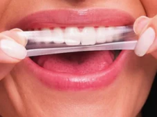 Imagem - Anvisa proíbe venda de fitas de clareamento dental famosas nas redes sociais