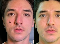 Imagem - 'Até o Pedrinho está envelhecendo': Namorado de Iza e ator de 'Sítio do Picapau Amarelo' realiza tratamento facial em clínica estética