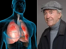 Imagem - Veja os sinais de alerta e como identificar a pneumonia, doença que matou Juca de Oliveira