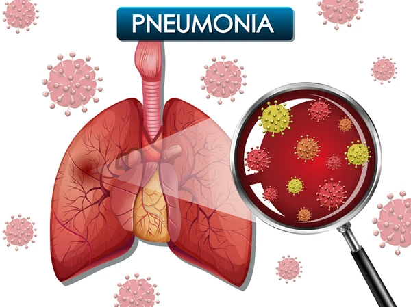 Pneumonia por Reprodução