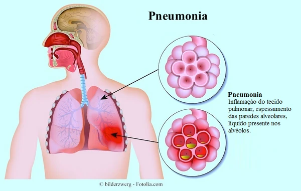Pneumonia por Reprodução