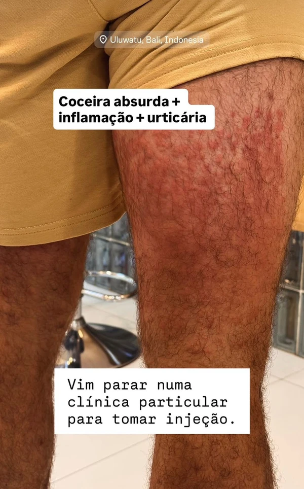 Lucas Malvacini, ex-ator da Globo, sofre ataque de ácaros em Bali por Reprodução/ Instagram