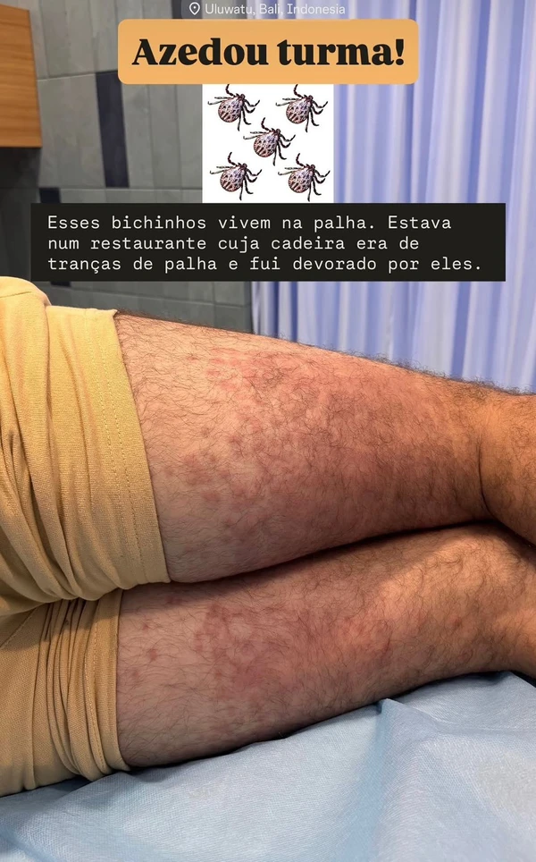 Lucas Malvacini, ex-ator da Globo, sofre ataque de ácaros em Bali por Reprodução/ Instagram