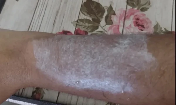 Fãs relatam queimaduras na pele após uso de pulseiras em show de Luan Santana em BH por Reprodução/Redes Sociais 