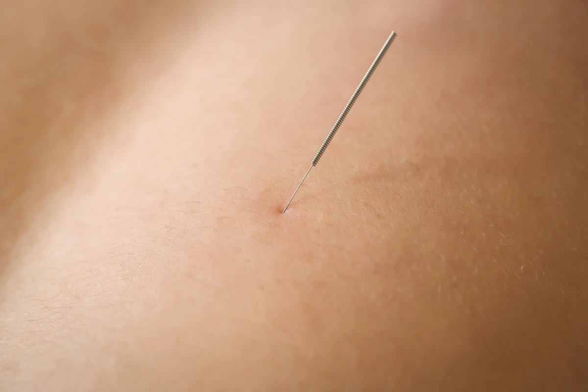 A profissional foi parar na Unidade de Terapia Intensiva (UTI) de um hospital após realizar duas técnicas no estabelecimento: uma liberação miofascial e um dry needling (agulhamento a seco). por Freepik