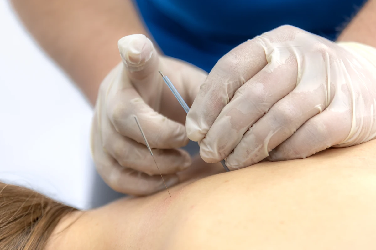 O dry needling (agulhamento a seco) é uma técnica fisioterapêutica invasiva que utiliza agulhas finas, sem medicamentos, para desativar pontos-gatilho (nódulos de tensão) e tratar a dor miofascial. Ele teria ocasionado as dores. por Freepik