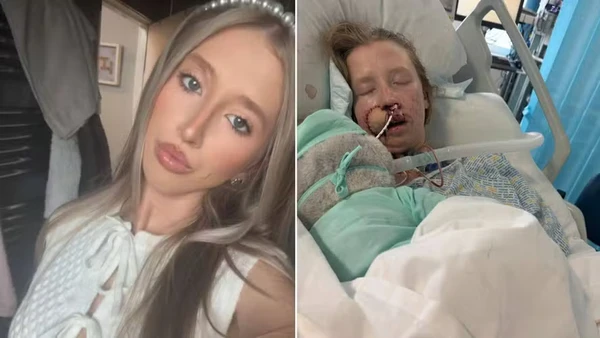 Jovem fica desfigurada após ataque de cão que ela convivia desde filhote: 'Só lembro dele indo direto no meu rosto'