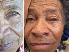 Imagem - 'Minha mãe está morrendo e ninguém faz nada', diz filha de idosa que perdeu visão após mutirão na Bahia