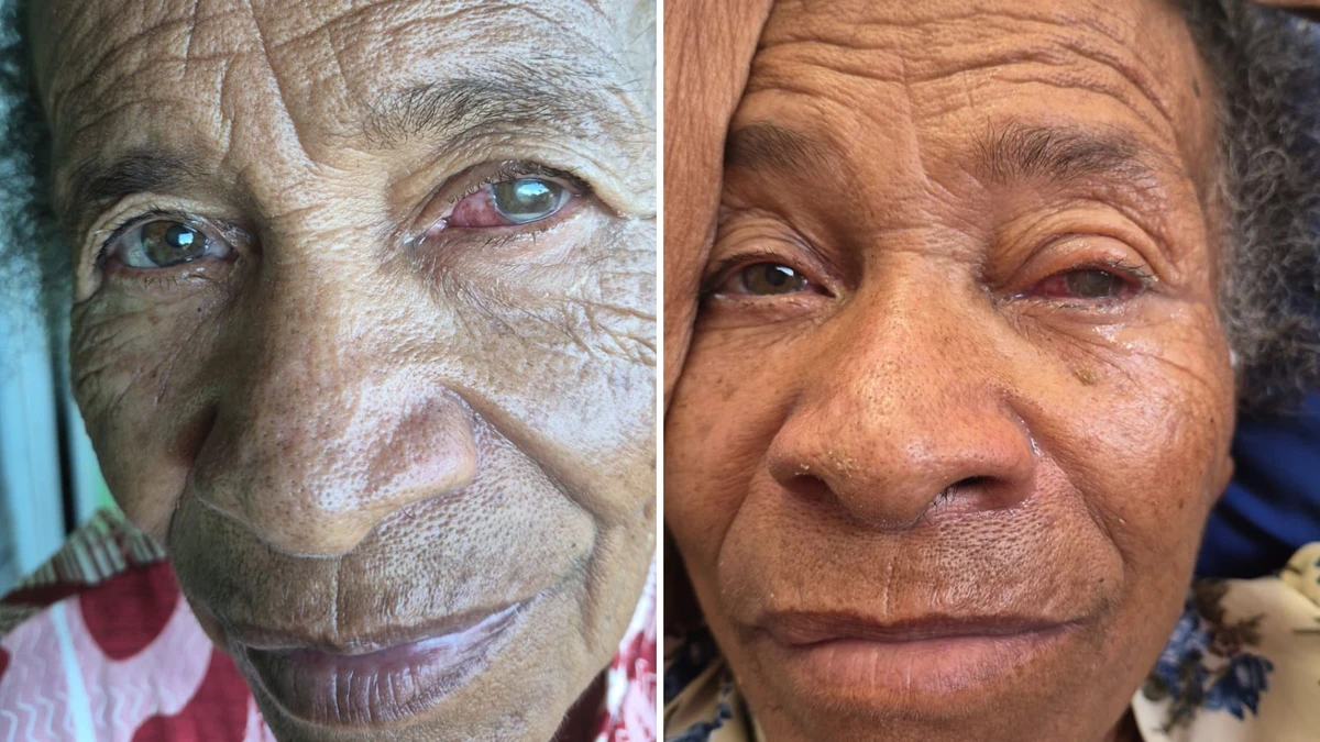 Idosa perdeu a visão de um dos olhos e tem dificuldades para enxergar no outro