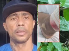 Imagem - Homem picado por cobra diz ter recebido 20 doses de soro errado em hospital: 'Quase custou a minha vida'