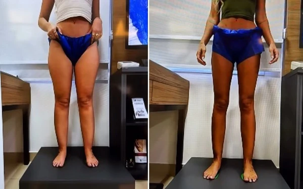 Yasmin Brunet mostrou antes e depois após perder 25kg por Reprodução/Instagram