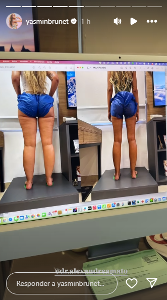 Yasmin Brunet mostrou antes e depois após perder 25kg por Reprodução/Instagram