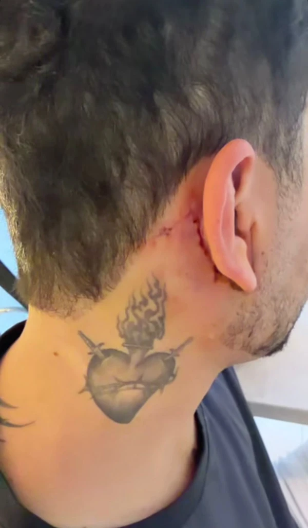 Cicatrização do procedimento de Carlinhos Maia por Reprodução/Instagram