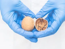 Imagem - Nódulo incolor, inchaço e sensação de peso podem indicar câncer no testículo; saiba mais sinais