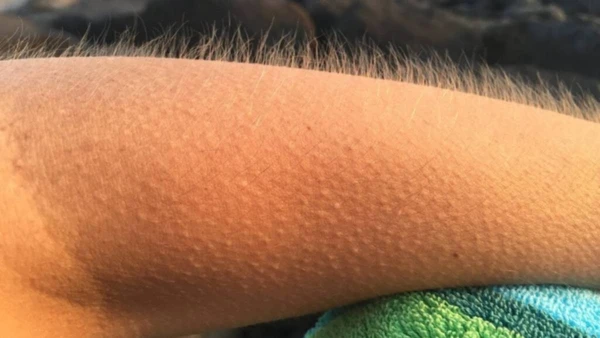 Entenda o fenômeno da 'frisson' e por que emoções intensas, músicas marcantes ou memórias profundas podem causar reações físicas imediatas na sua pele