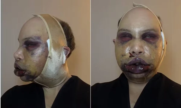 Ex-Big Brother Finlândia fez três cirurgias de uma vez e acaba cego por Reprodução/@hesselgrenjoni