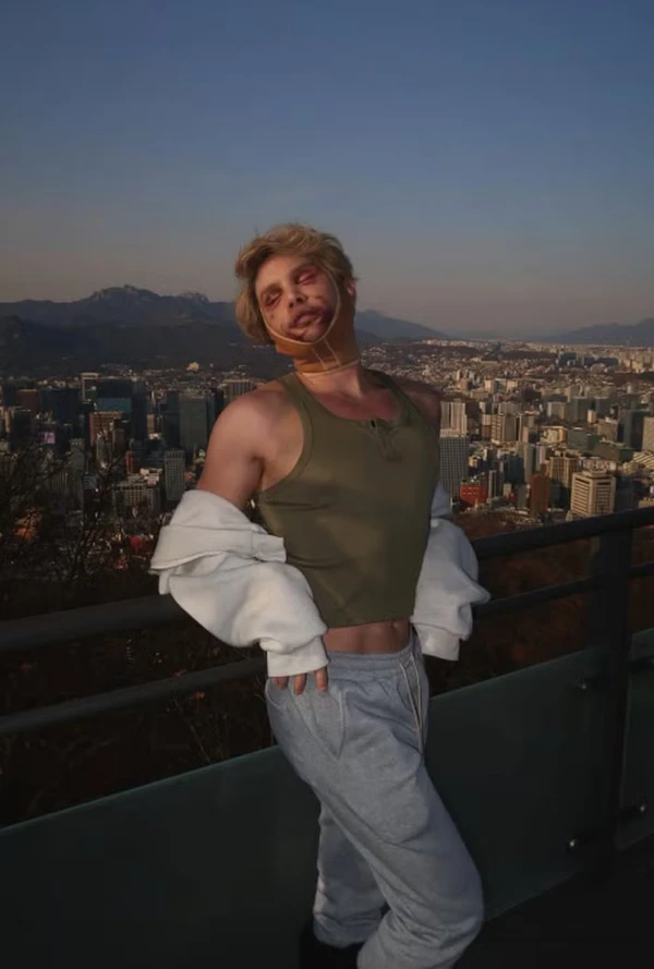 Ex-Big Brother Finlândia fez três cirurgias de uma vez e acaba cego por Reprodução/@hesselgrenjoni