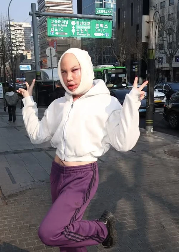 Ex-Big Brother Finlândia fez três cirurgias de uma vez e acaba cego por Reprodução/@hesselgrenjoni