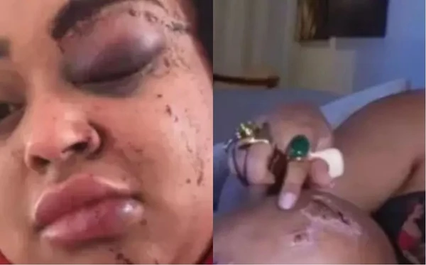 Rízia Cerqueira mostrou hematomas após acidente grave de moto elétrica em Maceió