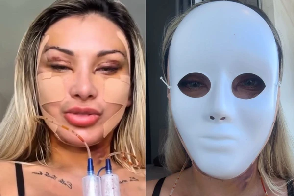  Andressa Urach faz procedimentos estéticos após divórcio: 