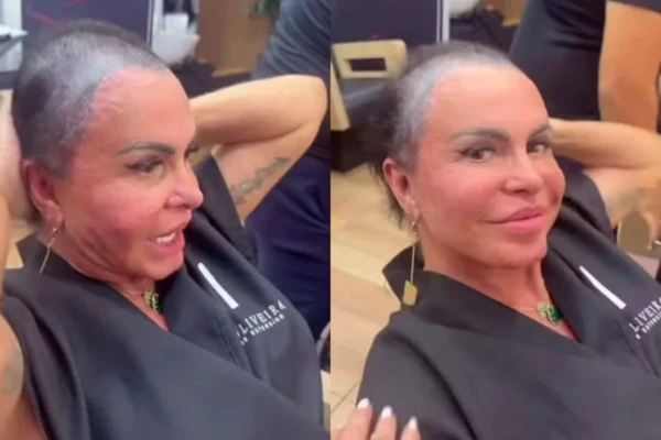Gretchen passa por tratamento para alopecia