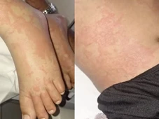 Imagem - Criança é internada com infecção bacteriana após ter contato com detergente da Ypê