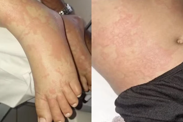 Criança é internada com infecção bacteriana após ter contato com detergente da Ypê