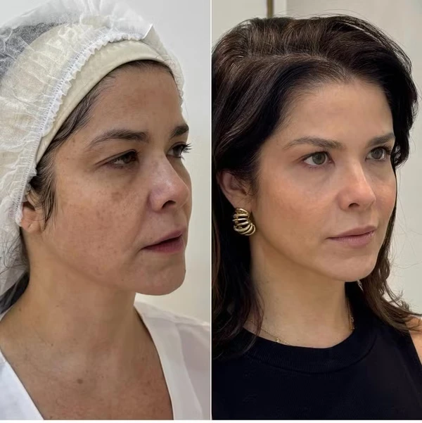 Samara Felippo antes e depois de rejuvenescimento facial por Reprodução/Instagram