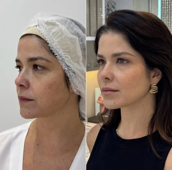 Samara Felippo antes e depois de rejuvenescimento facial por Reprodução/Instagram