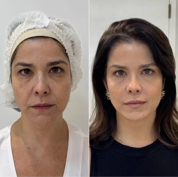Samara Felippo antes e depois de rejuvenescimento facial por Reprodução/Instagram