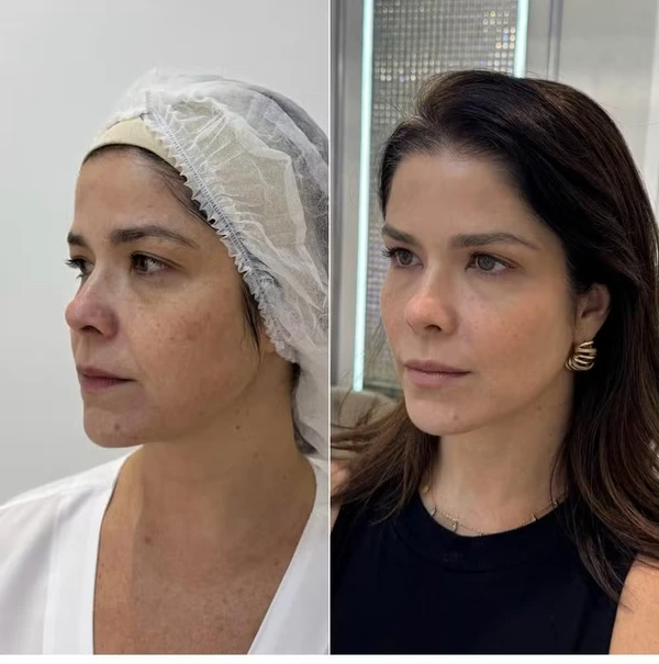 Samara Felippo antes e depois de rejuvenescimento facial por Reprodução/Instagram