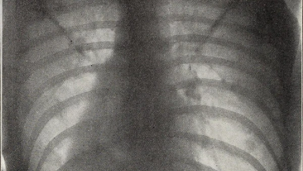 Apesar de diferentes, essas condições e a cardiomiopatia hipertrófica pertencem ao grupo das alterações estruturais do coração