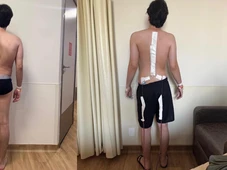 Imagem - Ombros desalinhados, assimetria na cintura e inclinação do tronco: escoliose pode ser silenciosa na adolescência