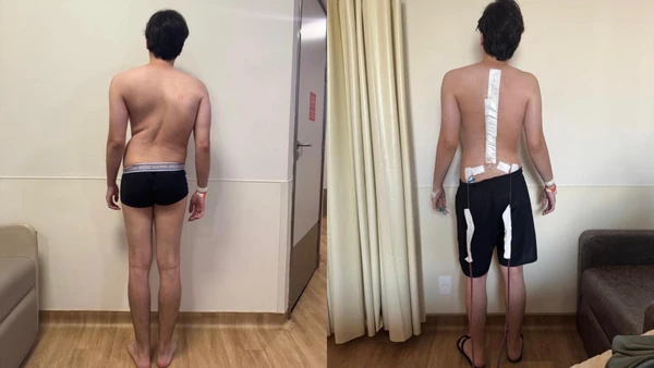 Ombros desalinhados, assimetria na cintura e inclinação do tronco: escoliose pode ser silenciosa na adolescência