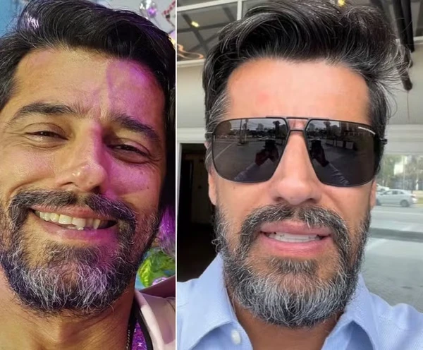 Alberto Cowboy coloca lente nos dentes