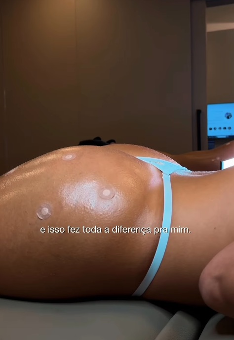 Vanessa Lopes passou por harmonização no bumbum por Reprodução/Instagram