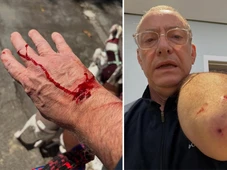 Imagem - Apresentador da Globo é atacado por pitbull: ‘Ele avançou e feriu a mim e a uma das minhas cachorras’