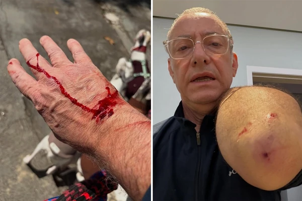 Apresentador da Globo é atacado por pitbull: ‘Ele avançou e feriu a mim e a uma das minhas cachorras’ por Reprodução