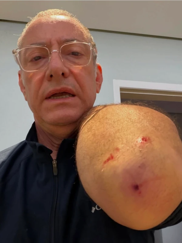 Apresentador da Globo é atacado por pitbull: ‘Ele avançou e feriu a mim e a uma das minhas cachorras’ por Reprodução
