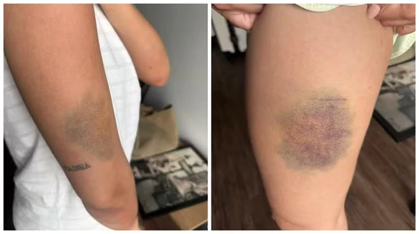 Nutricionista que escapou de estupro com um mata-leão revela como uma aula de defesa pessoal ajudou a salvar sua vida por Reprodução